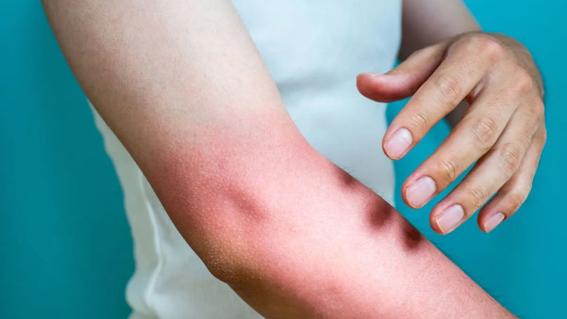 Soarele puternic este inamicul pielii: Medicii spun cum ne putem proteja