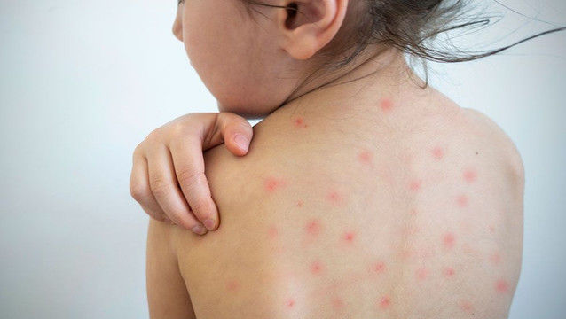 Trei cazuri noi de rujeolă: Medicii reiterează importanța vaccinării