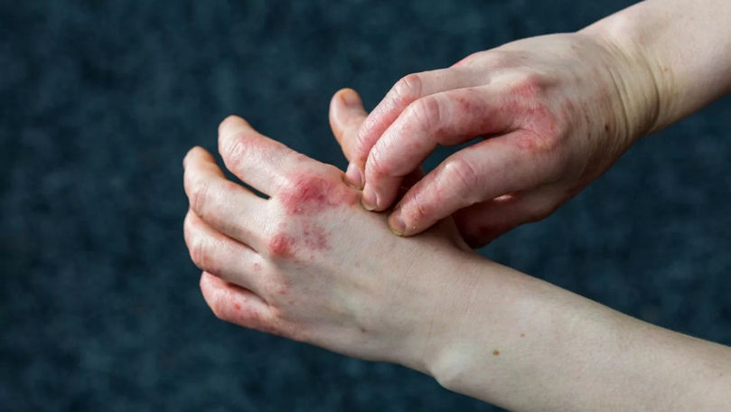 Cum îți dai seama că ai dermatită, potrivit specialiștilor