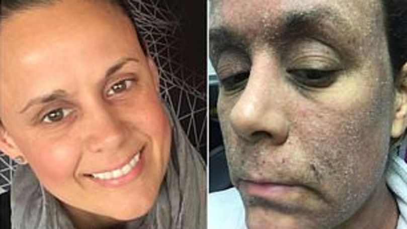 Femeia care a ajuns să arate ca un zombie după ce a folosit o cremă