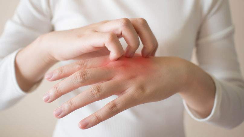 Ce e dermatita atopică, afecțiune tot mai întâlnită în rândul copiilor