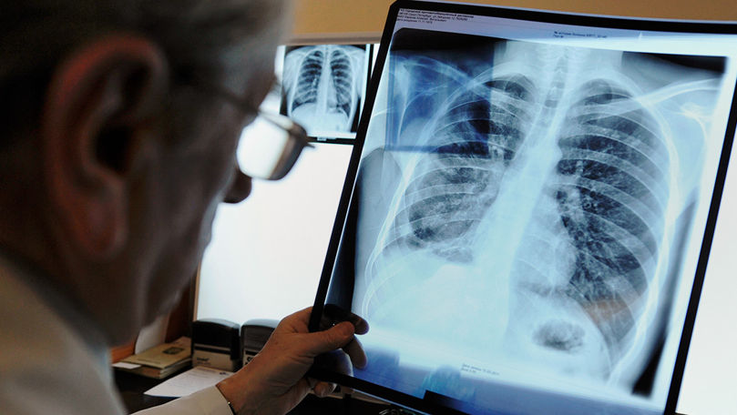 Власти планируют к 2030 году сократить заболеваемость туберкулёзом на 80%.