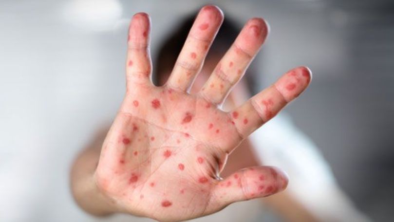 Всего лишь за четыре дня в семи уездах Румынии выявили 117 таких пациентов.