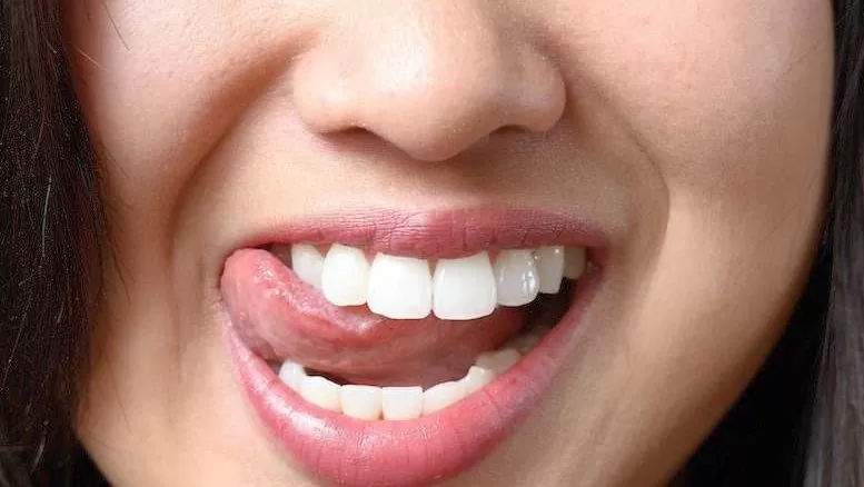 Cum putem scăpa de afte. Opt remedii naturale