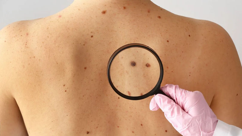 Cancerul de piele, o amenințare reală: Medicii trag un semnal de alarmă