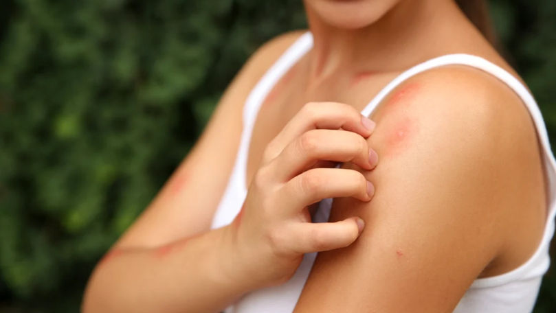 Șapte remedii naturale care te ajută împotriva înțepăturilor de țânțari