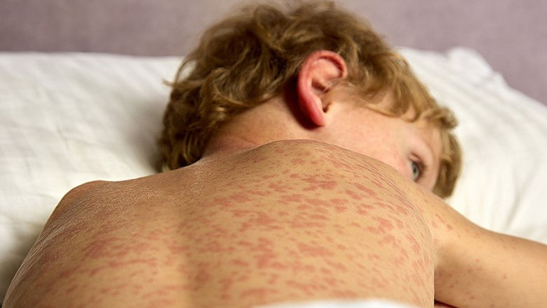 Минздрав призывает делать детям прививки от кори.