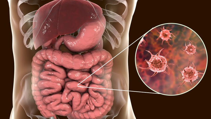 Record de infecții intestinale în regiunea transnistreană