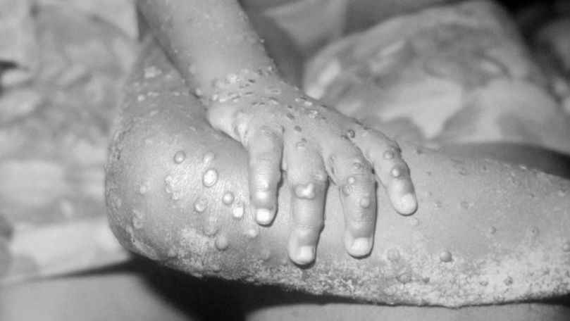 O boală rară a provocat alertă în SUA: Ce este variola maimuței