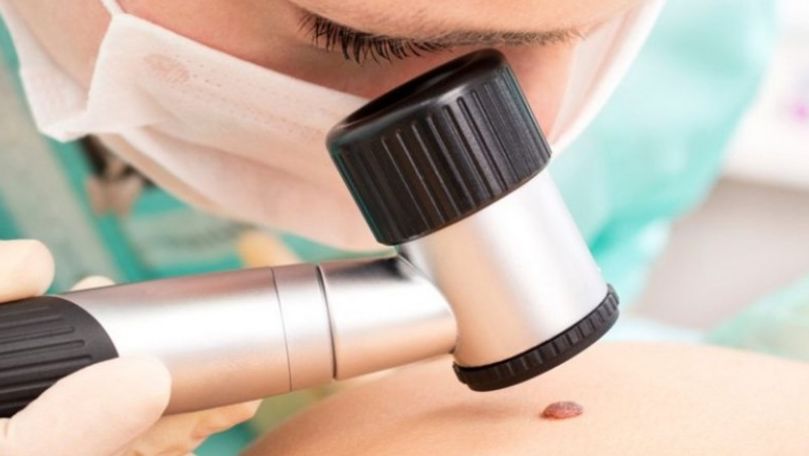 Medic dermatolog: Regulile după care distingem o aluniță periculoasă