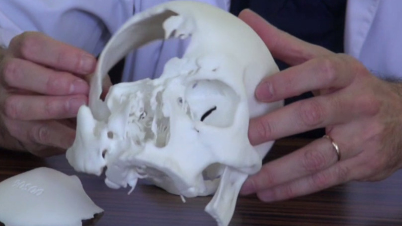 Medicii au reușit să reconstruiască parțial craniul unui tânăr