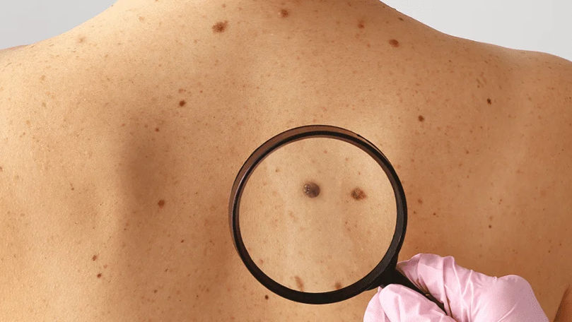 Tot mai multe cazuri de cancer de piele, înregistrate în R. Moldova