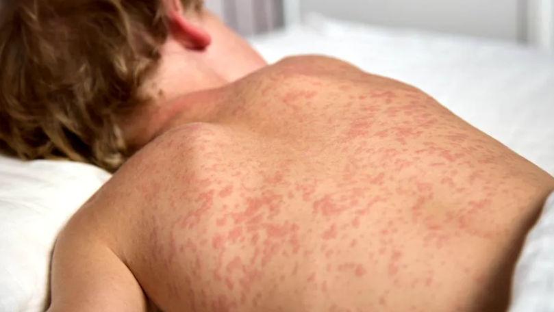 Dermatita atopică, tot mai frecventă la copii: Avertismentul medicilor