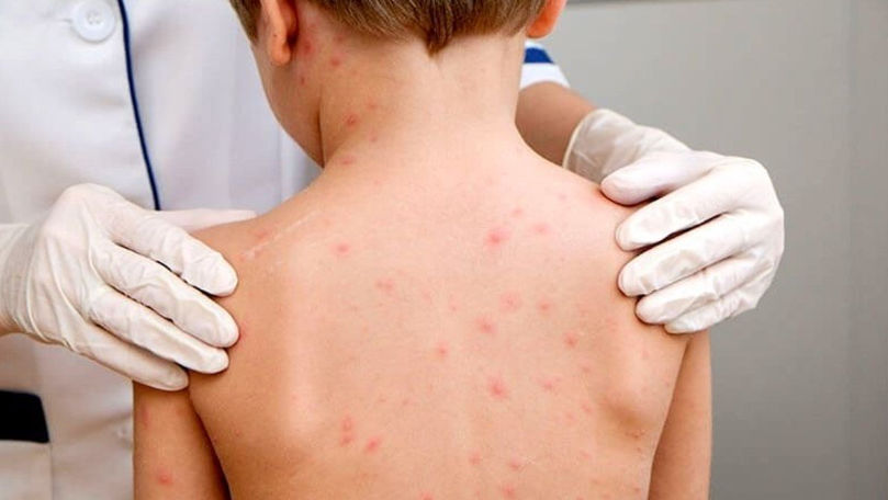Medic: Vaccinarea este singura protecție sigură împotriva rujeolei
