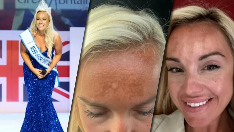 Bronzarea nazală, noul trend viral care crește riscul de cancer de piele