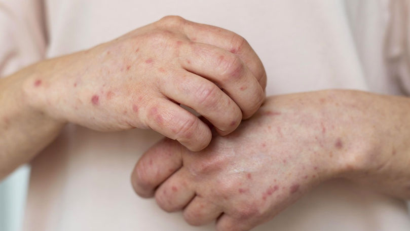 В Румынии подтвержден второй случай проказы.