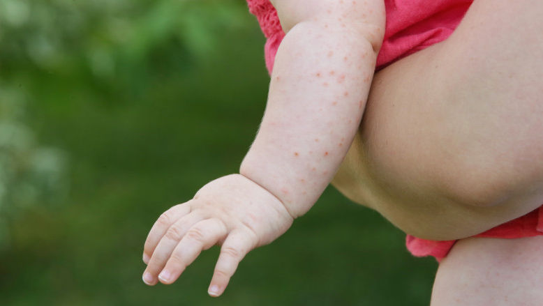 SUA se confruntă cu cea mai gravă epidemie de rujeolă din secolul XXI