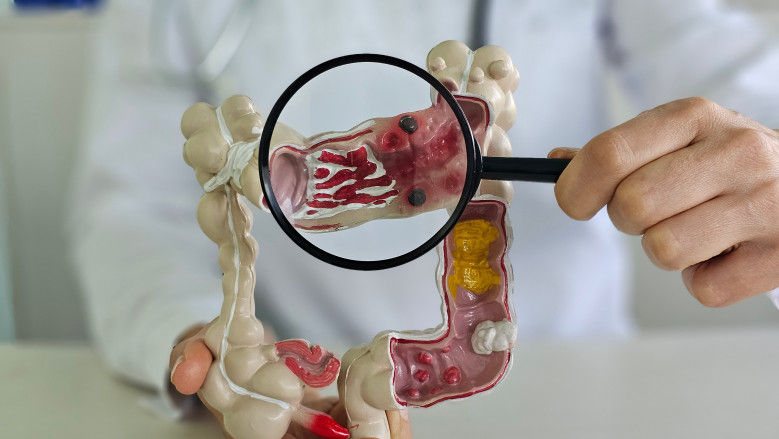 Cancerul colorectal afectează tot mai mulți tineri. Ce trebuie să știi