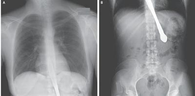 15-сантиметровый нож попал в пищевод после трюка. Фото: nejm.org