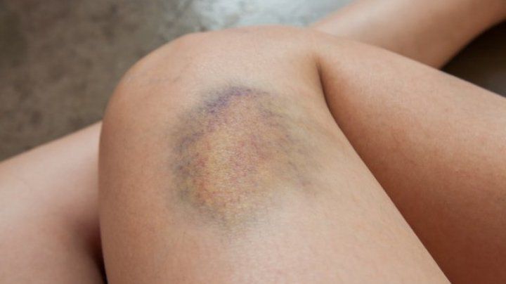 Principalele simptome ale cancerului pe care femeile le ignoră des