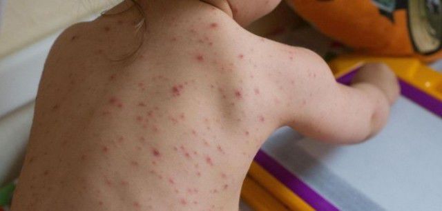 Epidemie de rujeolă în România şi Ucraina. Zeci de oameni au murit