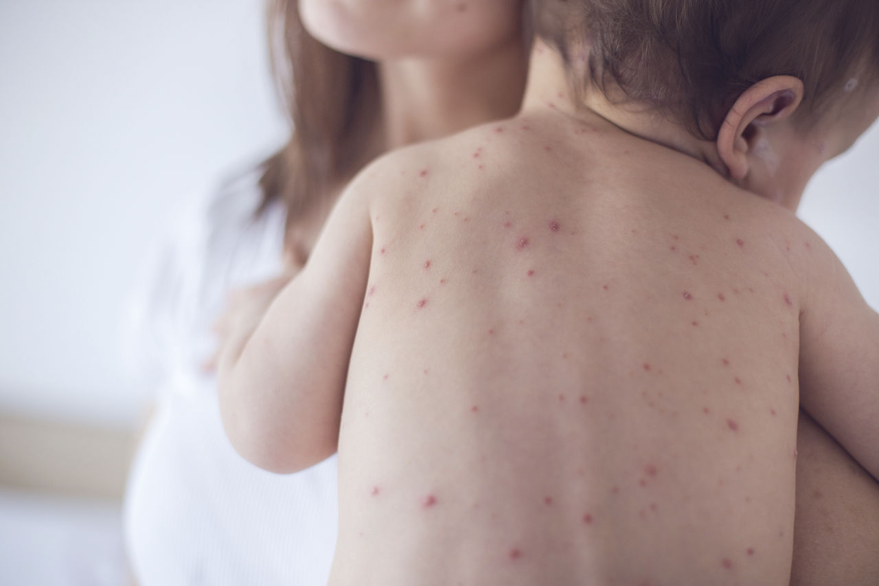 Alertă de rujeolă în România: E nevoie de măsuri urgente
