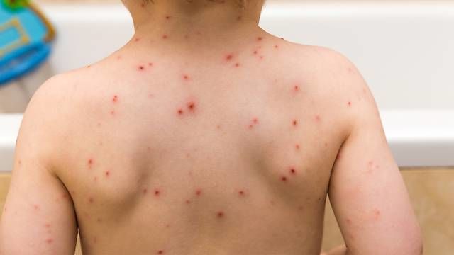 По всей стране сохраняется «желтый код» опасности распространения кори.