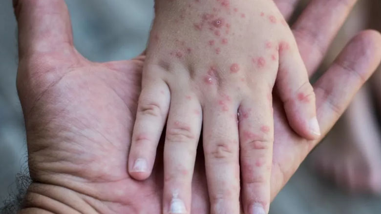 ANSP: 172 de cazuri de rujeolă, înregistrate de la începutul anului.