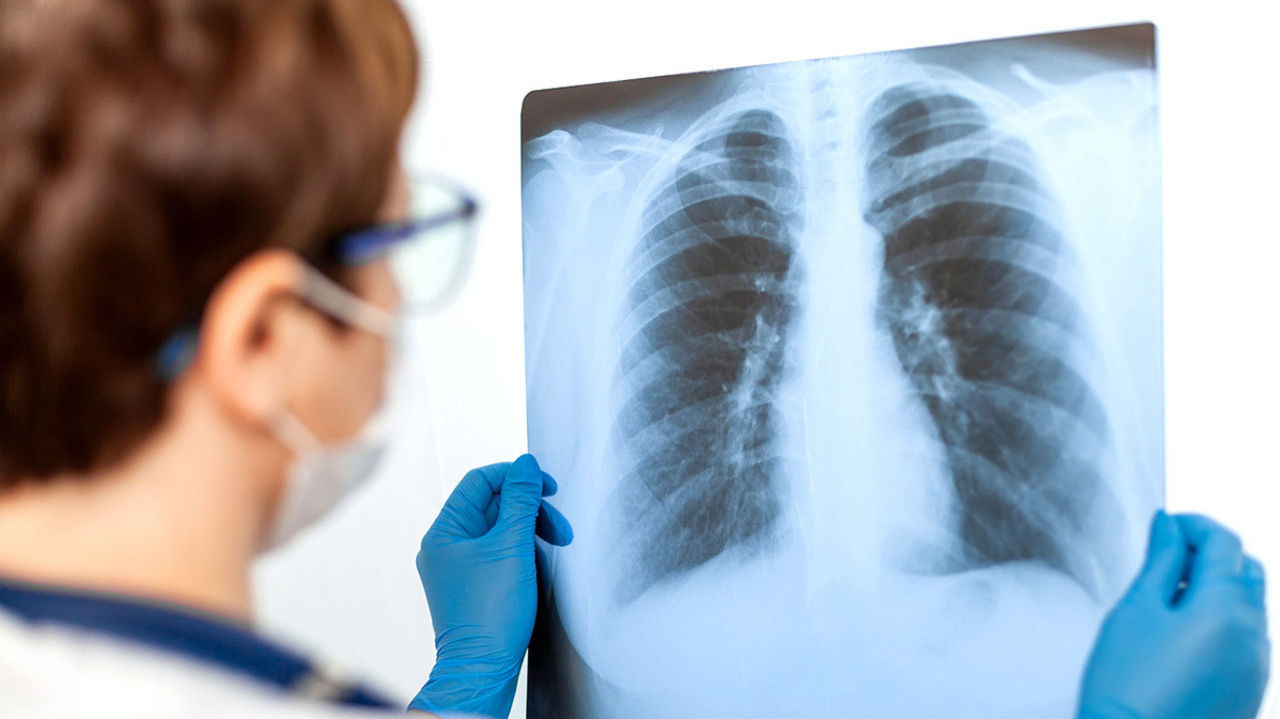 Pneumonia a provocat peste 1.000 de decese în Moldova în 2024: Printre victime sunt și copii.