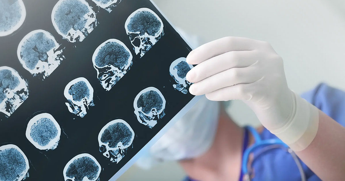 Studiu: Accidentele vasculare cerebrale afectează mult mai frecvent persoanele sărace.