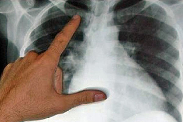 Cazurile de tuberculoză depistate tardiv vor fi reduse. Foto: ipn.md