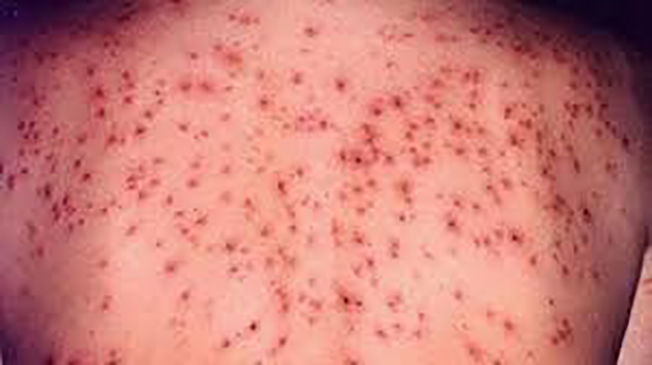 Primăria Chișinău, alertată de epidemia de rujeolă din Ucraina și România