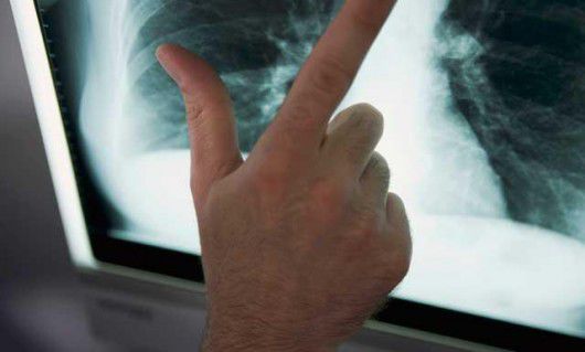 În 2013, la nivel mondial s-au depistat 9,0 milioane de cazuri noi de TB şi 1,5 milioane de oameni au murit.