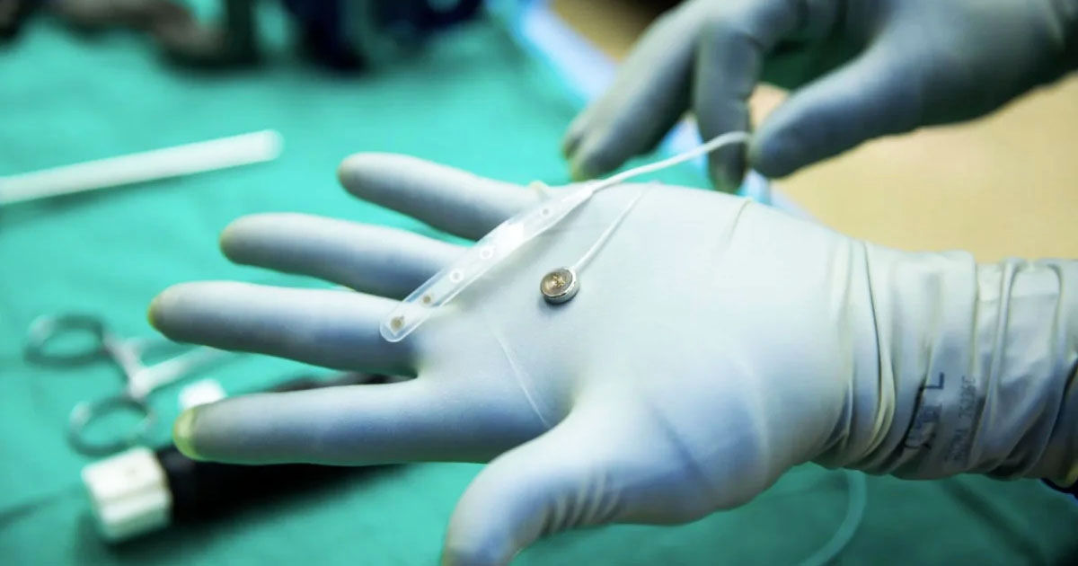 SUA au aprobat pentru prima dată testele pe oameni ale unui implant cerebral pentru restabilirea vorbirii.