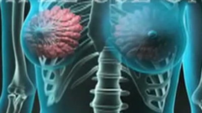 Datele Institutului Oncologic arată că, în anul 2012, incidenţa cancerului de sân era de 47 la 100.000 de locuitori.