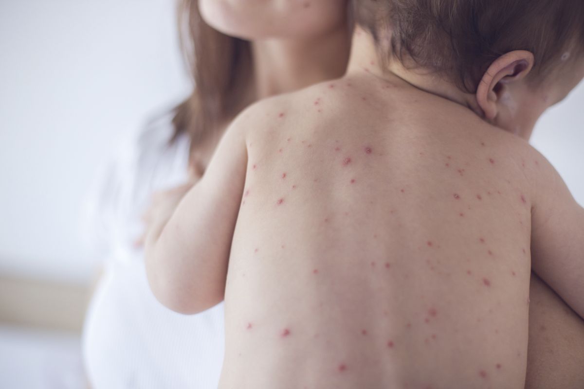 Stare de alertă în Ucraina, unde epidemia de rujeolă ia amploare.