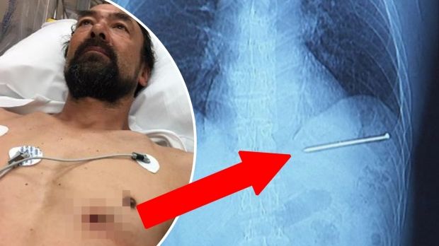 A condus cu un cui de 9 cm în inimă până la spital.