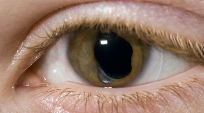 Operație de cataractă în Moldova: 37 de milioane de lei, alocate