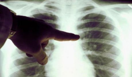 Patru copii din Moldova mai mici de șase ani au fost diagnosticați anul trecut cu tuberculoză abia după moarte. Foto: lesechos.fr
