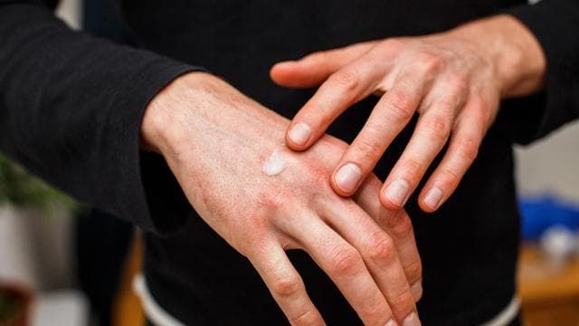 Эксперт назвала поражение кожи одним из признаков COVID-19.