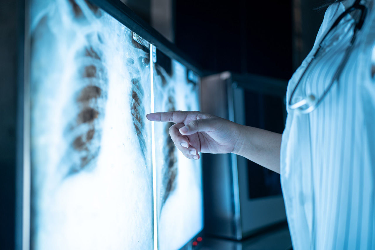 Studiu: COVID-19 și gripa pot crește riscul de dezvoltare a cancerului.