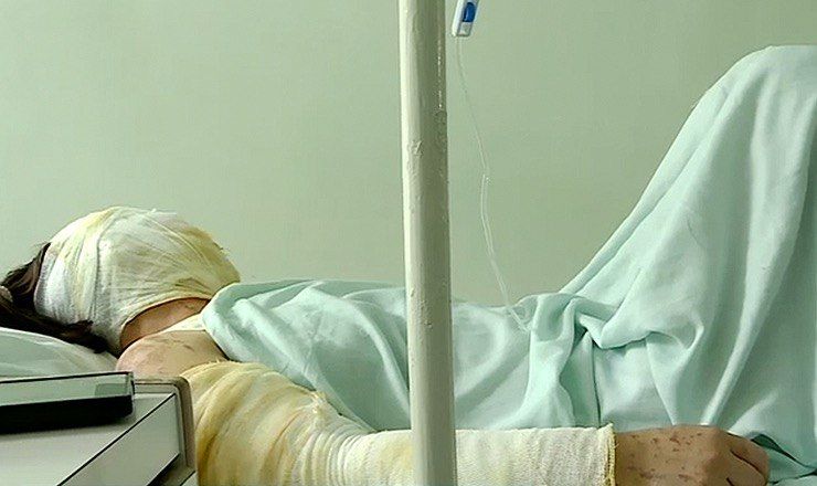 Женщина была облита неизвестным веществом и получила множественные ожоги лица и тела.