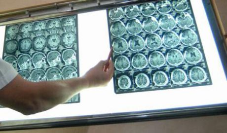 A fost identificată zona din creier afectată de autism. Foto: poză simbol/Agerpres
