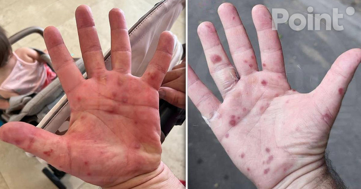 Un focar de virus cu simptome severe a fost înregistrat în Turcia.