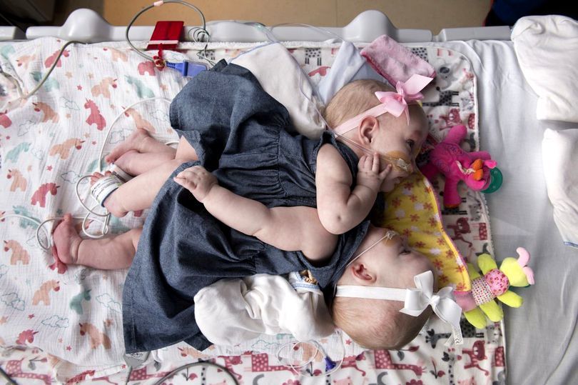 Siameze care aveau inimile lipite au supraviețuit operației de separare