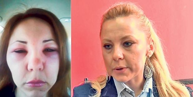 Raluca Crişan, avocata de la Alba Iulia care s-a trezit cu faţa tumefiată după o vizită la medicul estetician, a primit diagnosticul final din partea medicilor.