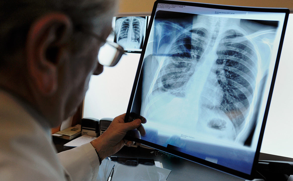 Autoritățile țintesc reducerea tuberculozei cu 80% până în 2030.