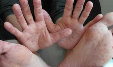 Vacanţă în Turcia: Zece moldoveni au contractat virusul Coxackie. Foto simbol: ziarelive.com