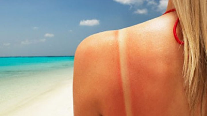 Arsurile solare se pot trata cu vitamina D. 
