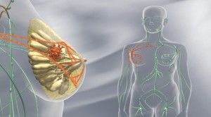 Medicamentul, numit anastrozol poate cauza dureri articulare și alte efecte secundare asemănătoare simptomelor menopauzei.